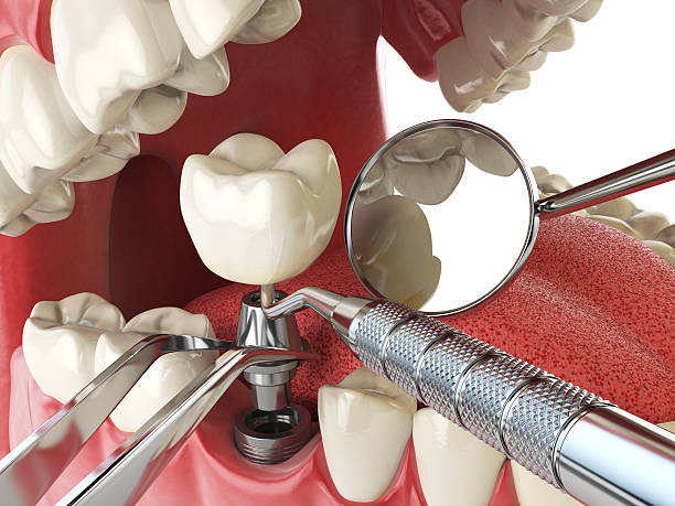 Best Lost Filling or Crown Replacement in Irwin, PA